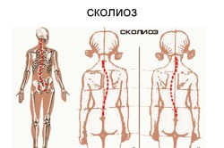 Сколиоз
