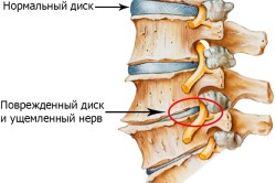 Шейные диски в позвоночнике