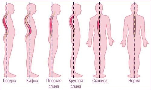 Виды искривлений позвоночника Виды искривлений позвоночника