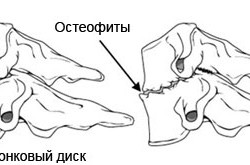 Остеофит - причина стеноза позвоночника