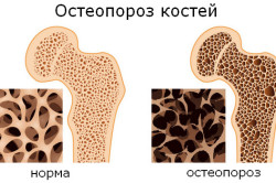 Остеопороз - причина нарушения грудного отдела позвоночника