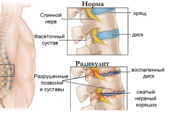 Схема радикулита Схема радикулита