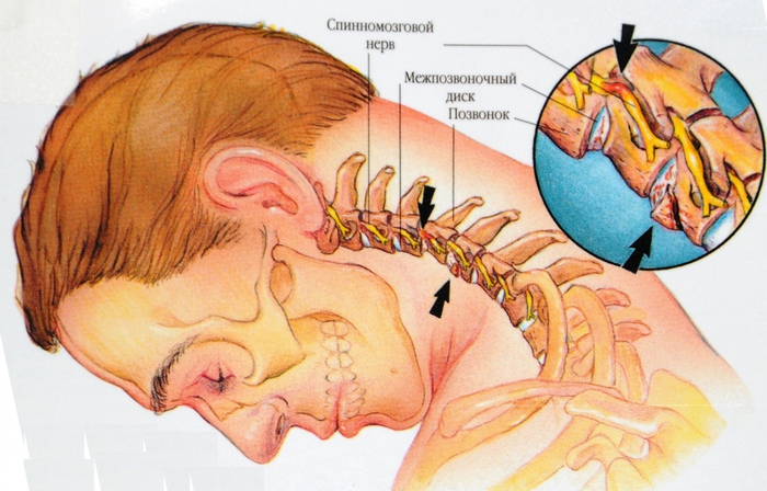Как сделать боль в шее