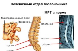 Поясничный отдел позвоночника на МРТ