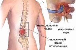 Схема грыжи поясничного отдела позвоночника
