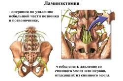 Принцип ламинэктомии Принцип ламинэктомии