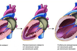 Инфаркт - причина болей под ребрами